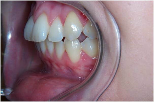 Lingual Invisible Brace