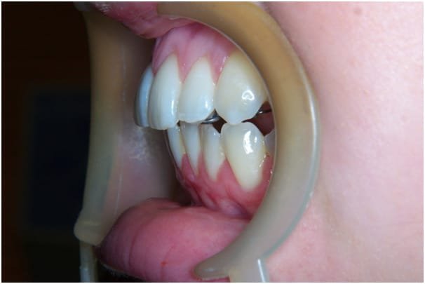 Lingual Invisible Brace